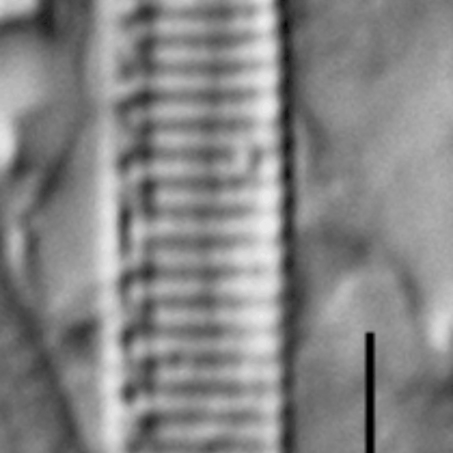 Duplicate Subacicularis 113094Arev002